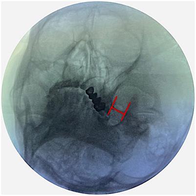 Percutaneous balloon compression of trigeminal ganglion under conscious sedation local anesthesia for the treatment of primary trigeminal neuralgia—A prospective cohort study